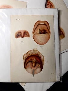 Vintage Oral Disease Medical Prints