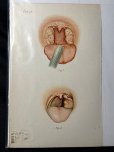 Vintage Oral Disease Medical Prints